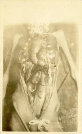 Photograph of Dr. Beckwith's first autopsy - hernia specimen
