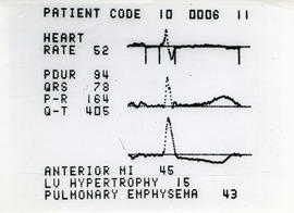Photograph of a patient's electrocardiogram results